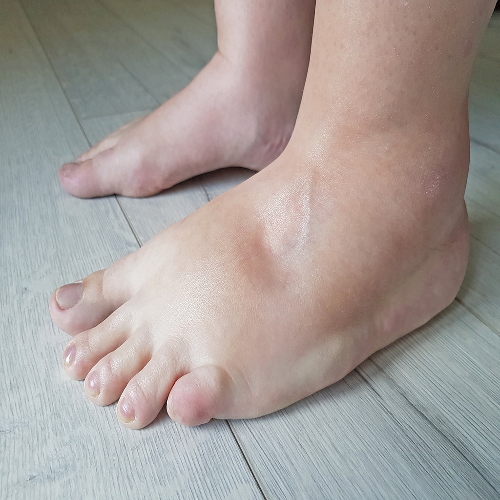 Diabetic Stollen Foot